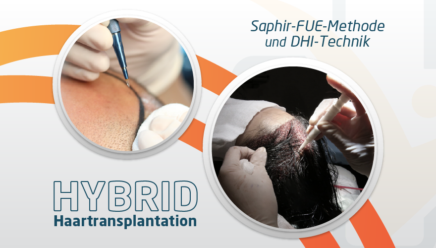 Hybrid Haartransplantation Turkei