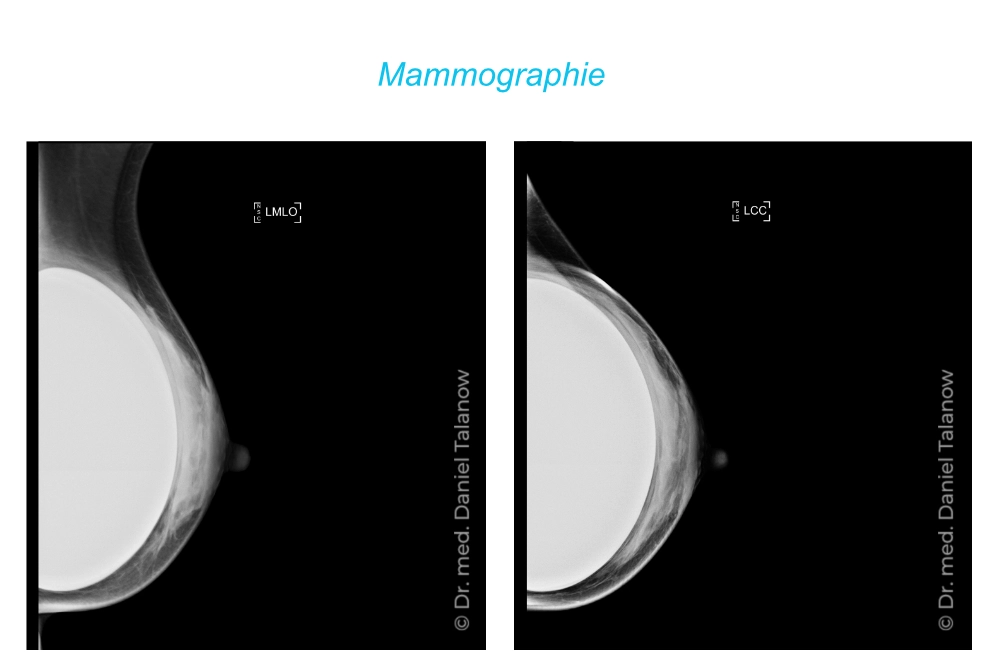 Mammografie und Brustimplantate: Was Sie wissen müssen