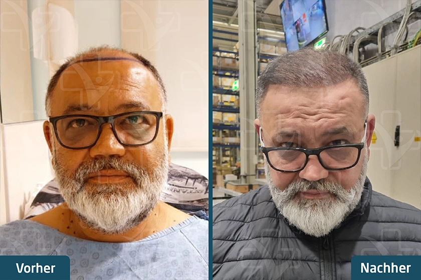 Saphir FUE Haartransplantation Türkei Vorher Nachher