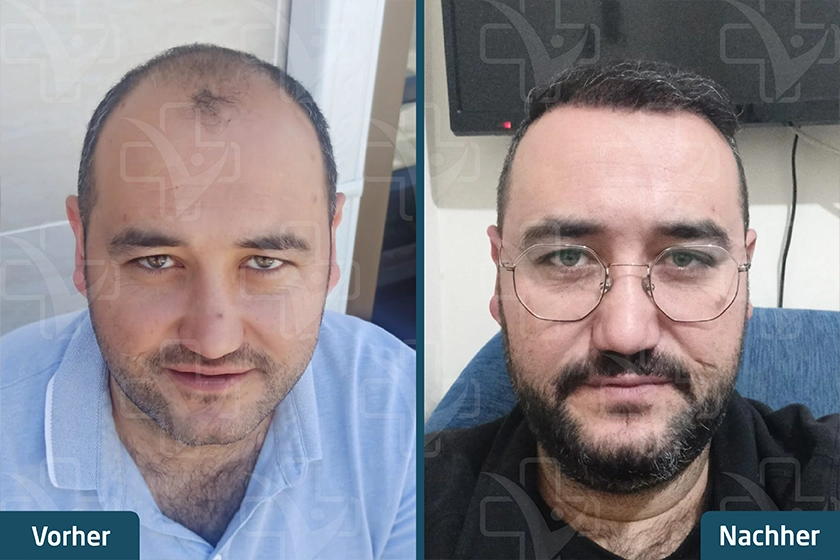 Saphir FUE Haartransplantation Türkei Vorher Nachher